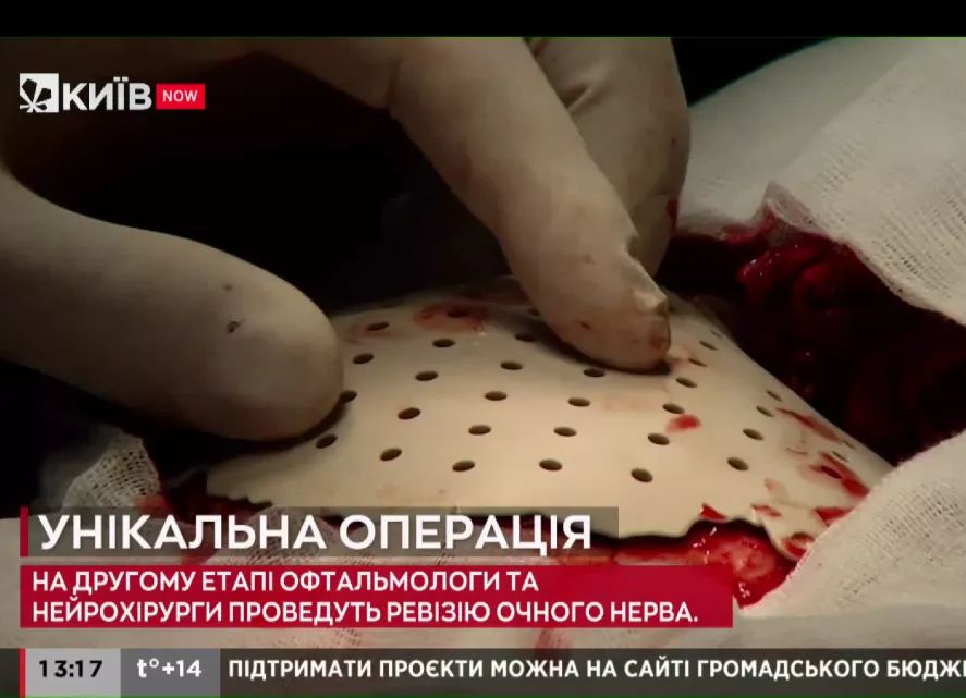 Exclusive interview from Ukraine：the 1st cranioplasty case with PEEK