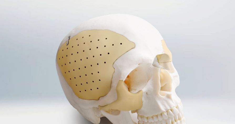 Recranio™ Cranio-Maxillofacial repair system